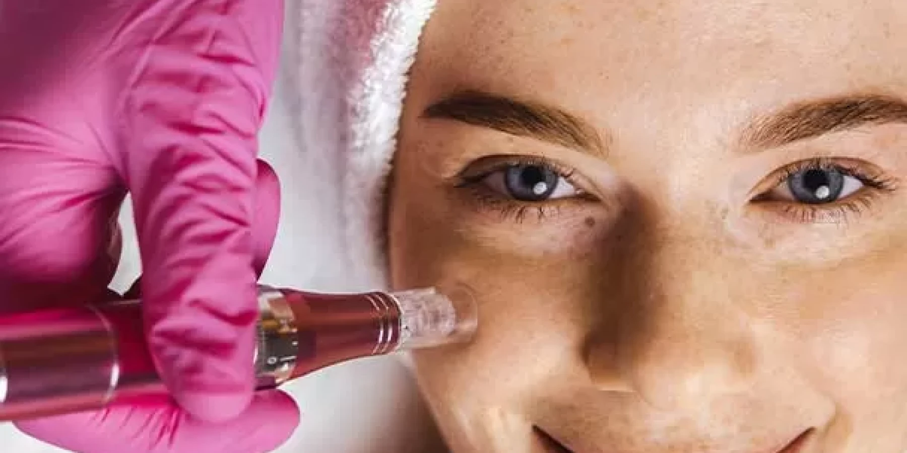 Cilt Yenileme İçin Dermapen