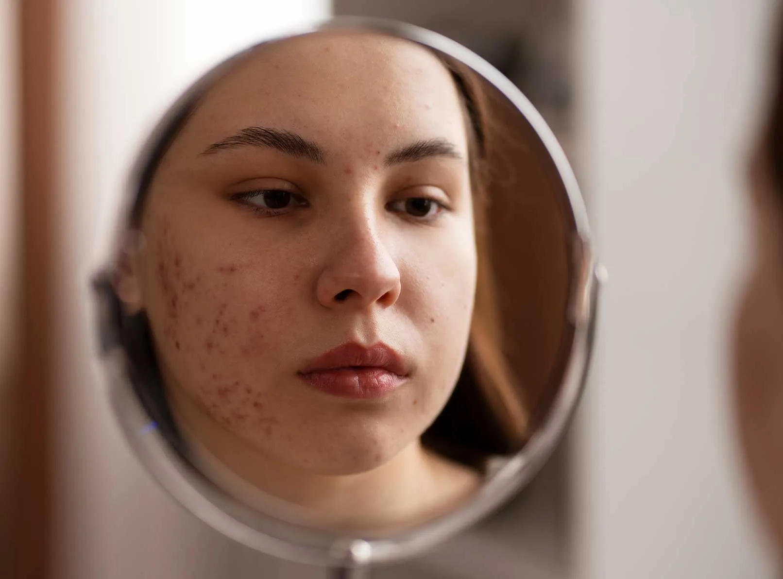 Acne Care: Why You Should Seek Professional Help