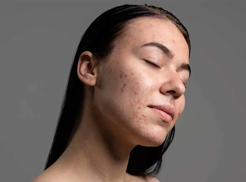 Innovations in Acne Care: What Are the Most Effective Solutions?