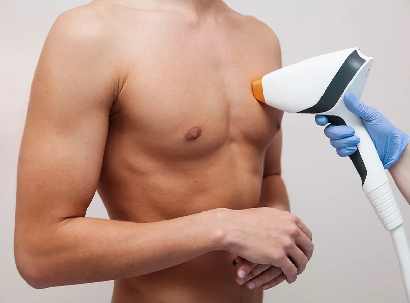 Men’s Laser Hair Removal: Effective and Safe Treatments