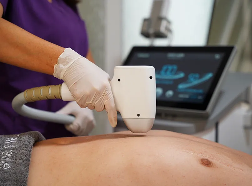 Erkek Lazer Epilasyon: Kalıcı Konfor İçin Uygulama Rehberi