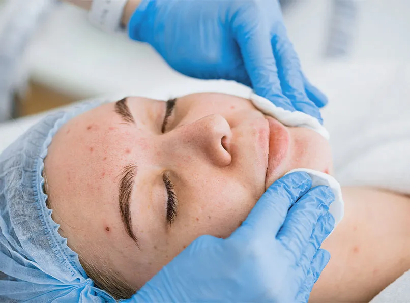 Spot and Acne Care: Personalized Solutions for Skin Blemishes