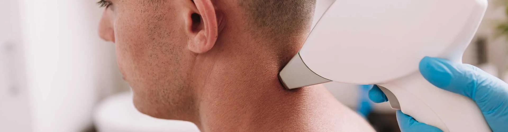 Nape Laser Hair Removal (Male)