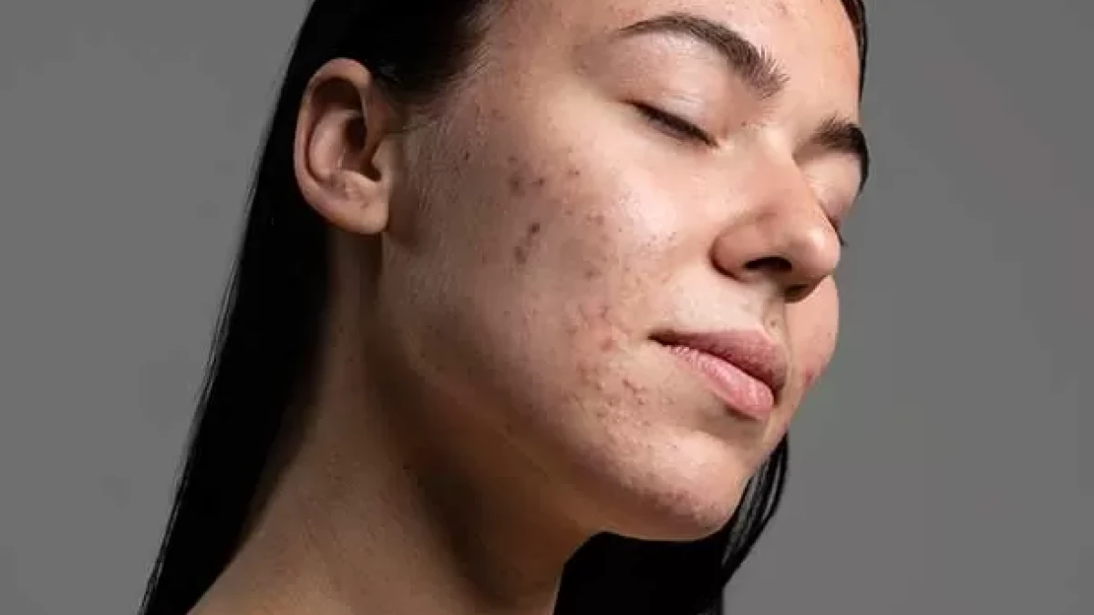 Innovations in Acne Care: What Are the Most Effective Solutions?
