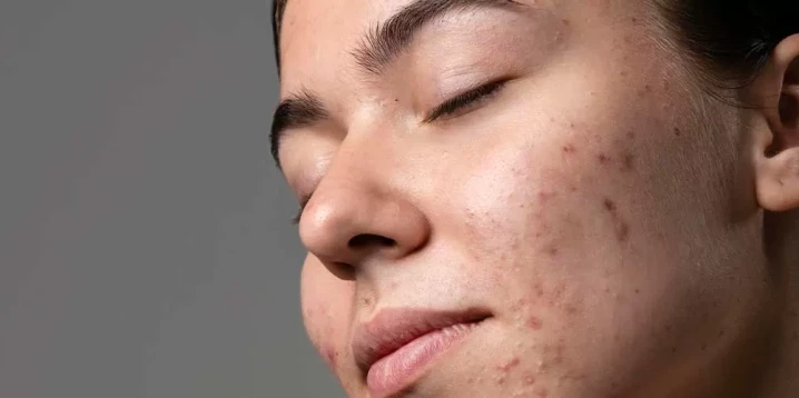 Innovations in Acne Care: What Are the Most Effective Solutions?