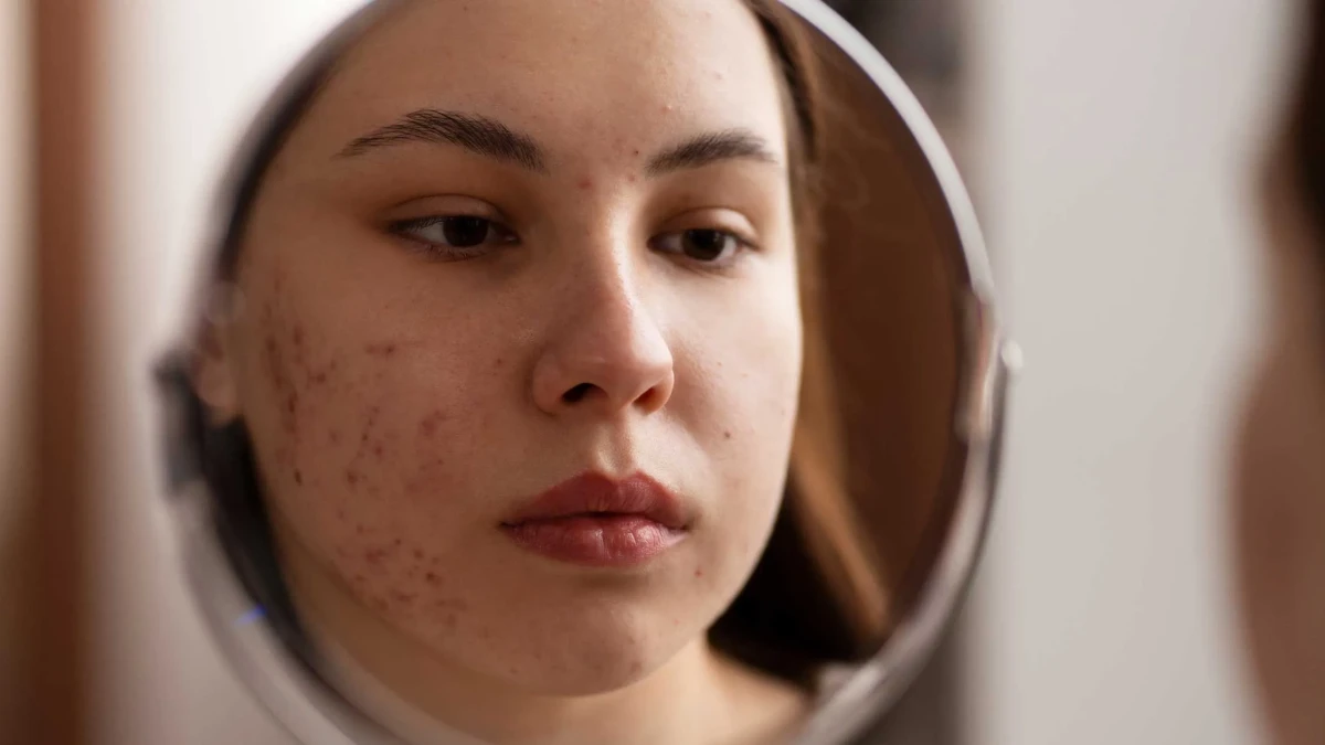 Akne Bakımı: Neden Profesyonel Yardım Almalısınız?