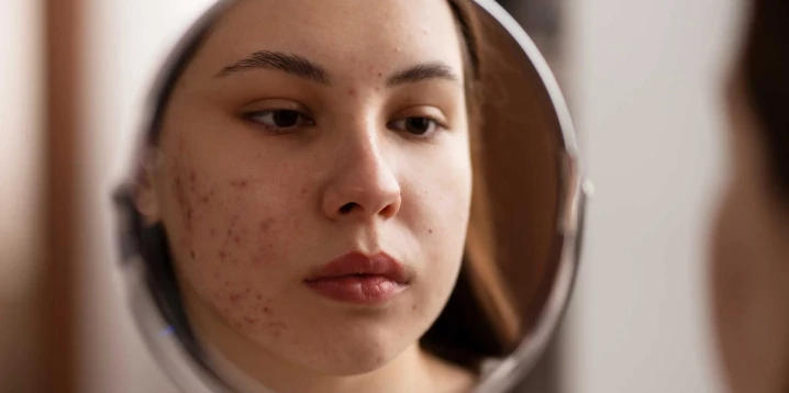 Acne Care: Why You Should Seek Professional Help