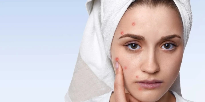 Akne Sonrası Lekeler İçin Etkili ve Kalıcı Çözümler