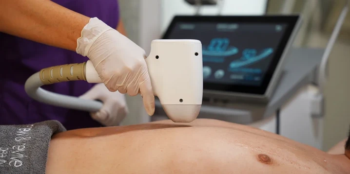 Erkek Lazer Epilasyon: Kalıcı Konfor İçin Uygulama Rehberi