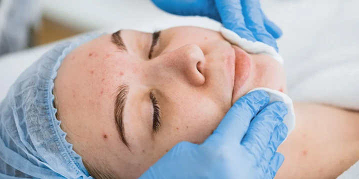 Spot and Acne Care: Personalized Solutions for Skin Blemishes