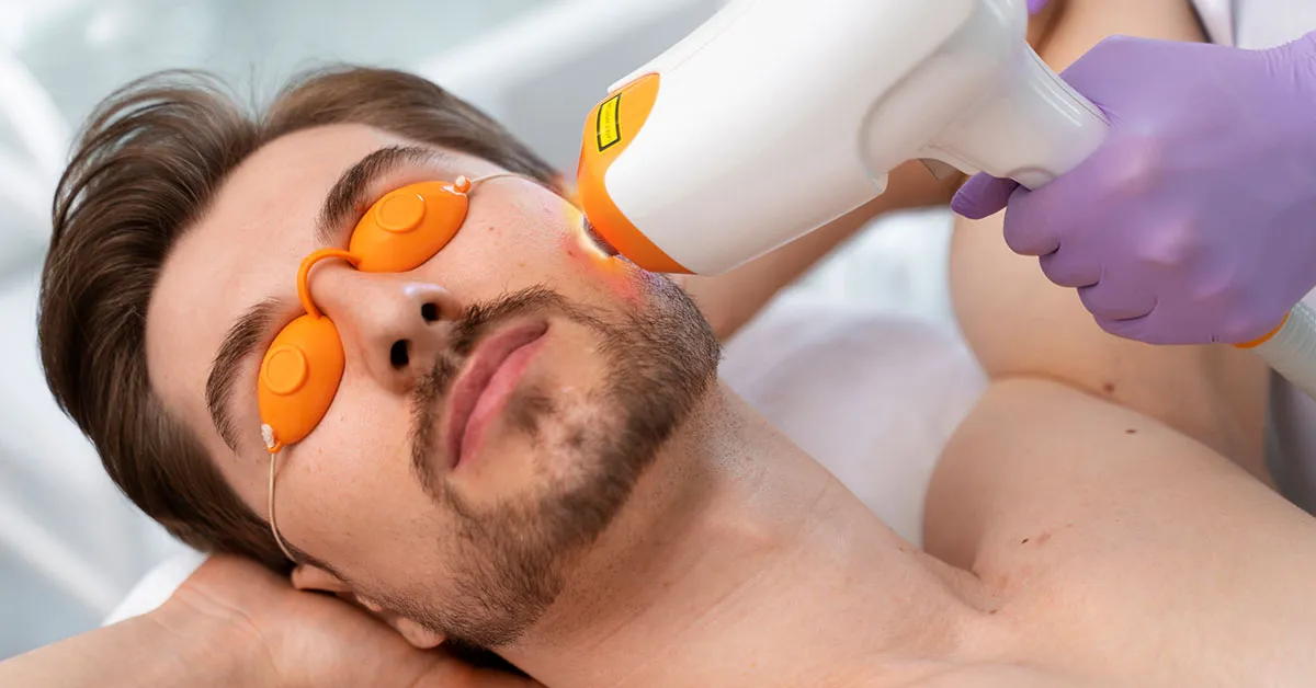 Upper Beard Laser Hair Removal: A Guide to a Sharp Beard Line